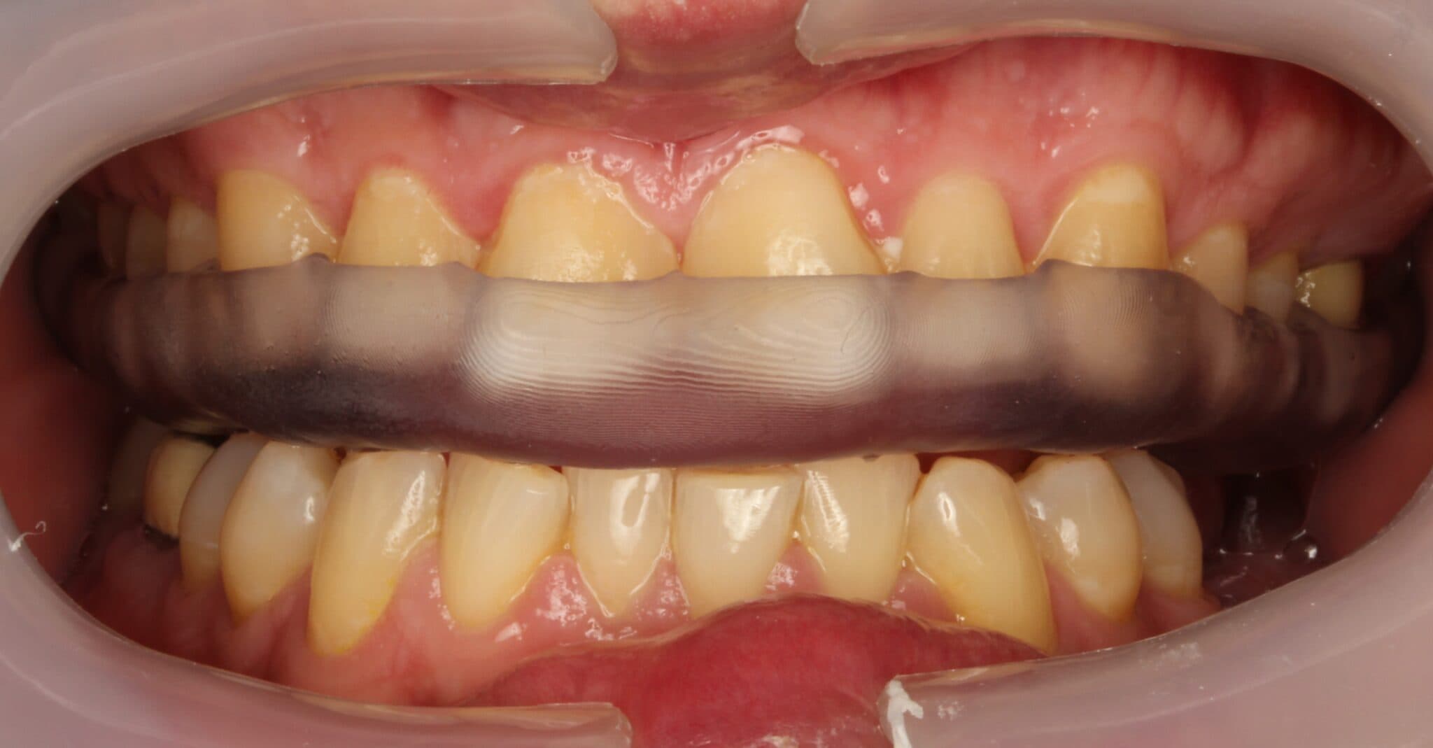 Figure 7: Perfect fit with no occlusal adjustments required. This printed splint was *chef’s kiss*!