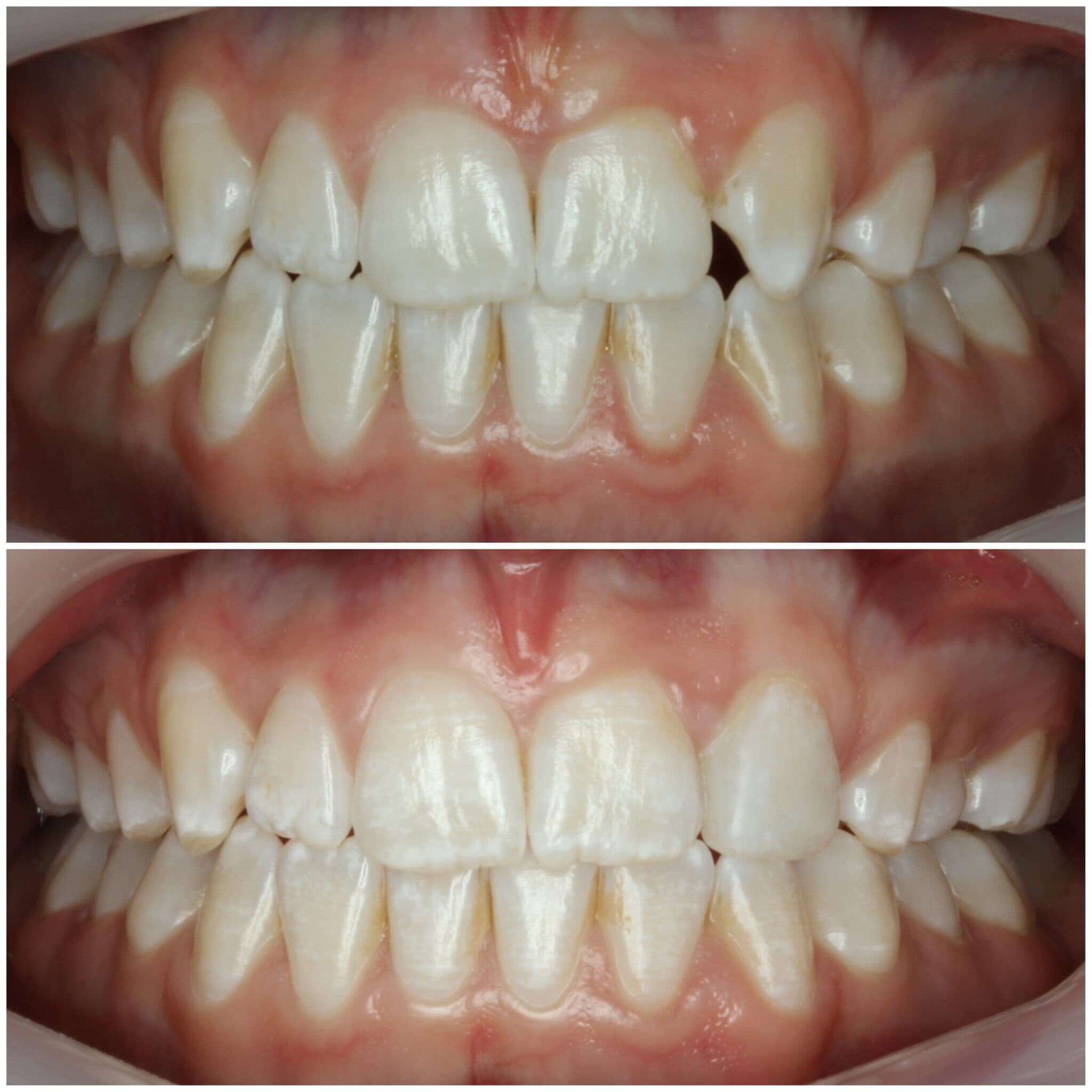 Figure 5: Minimal prep 3D-printed veneer (Rodin Sculpture 2.0) on tooth #23