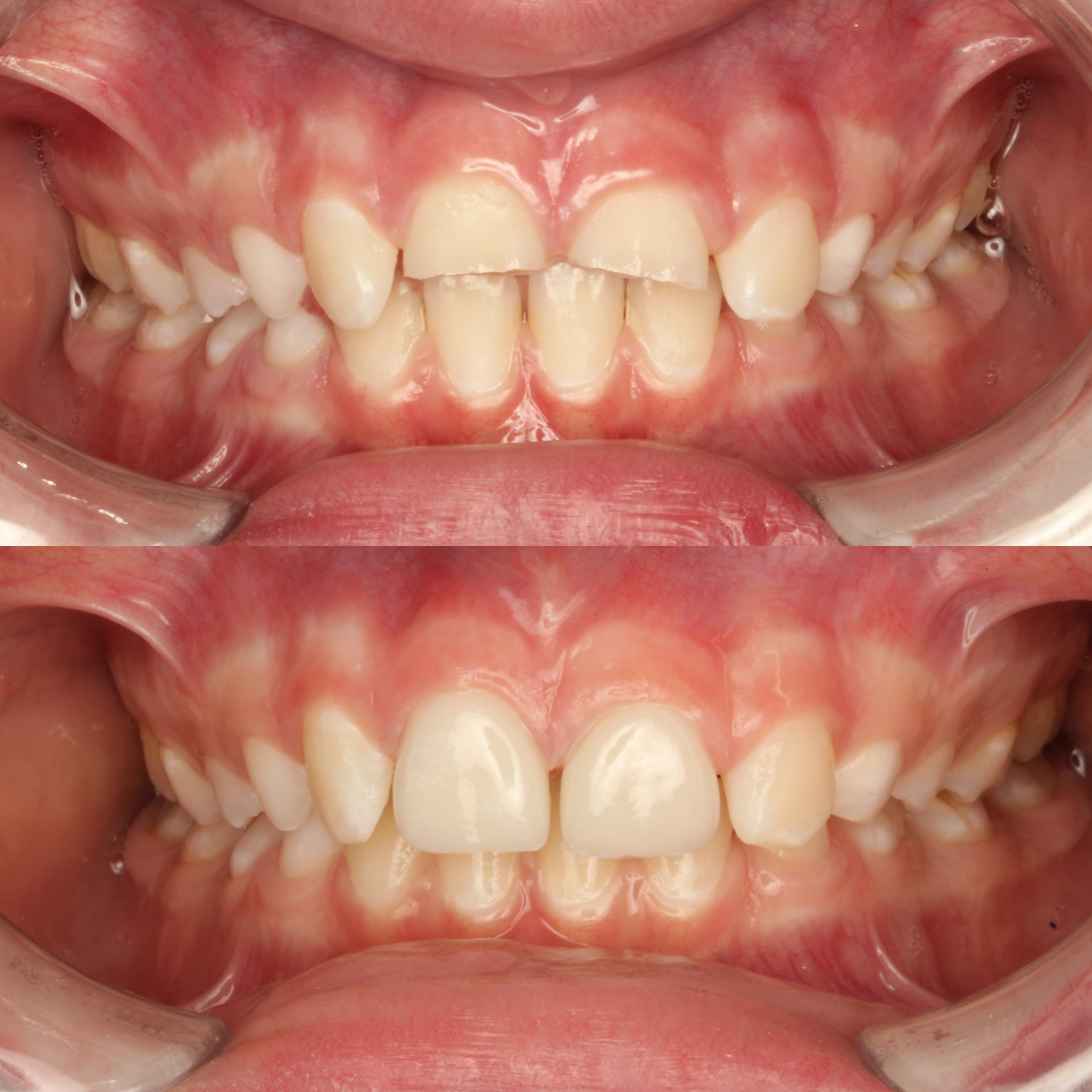 Printed Bego TriniQ veneers