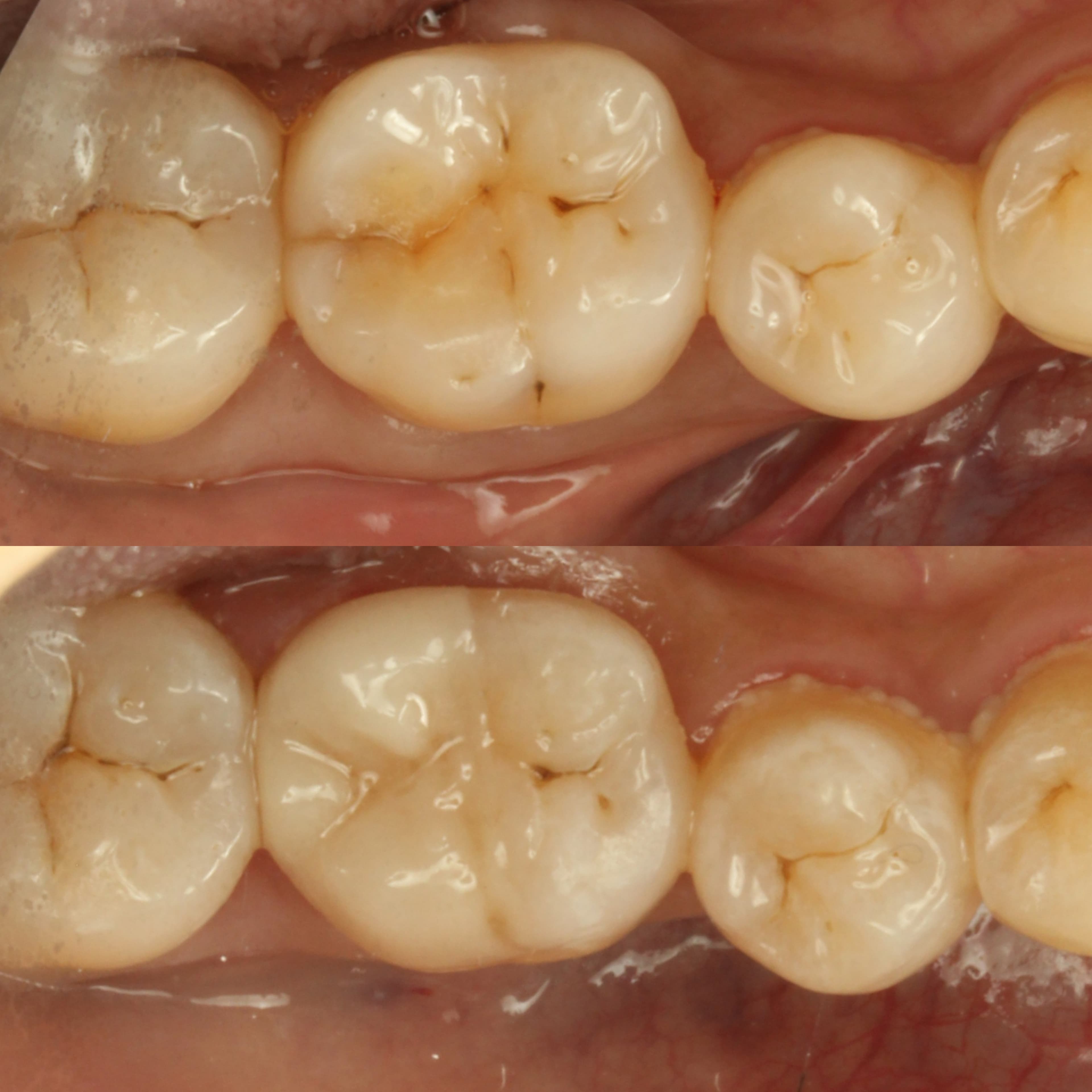 Figure 5: Same-appointment 3D printed onlay on the lower right first molar using Lumicera A3 (LT) characterised with Rodin Palette 2.0 and Glaze N2-Free