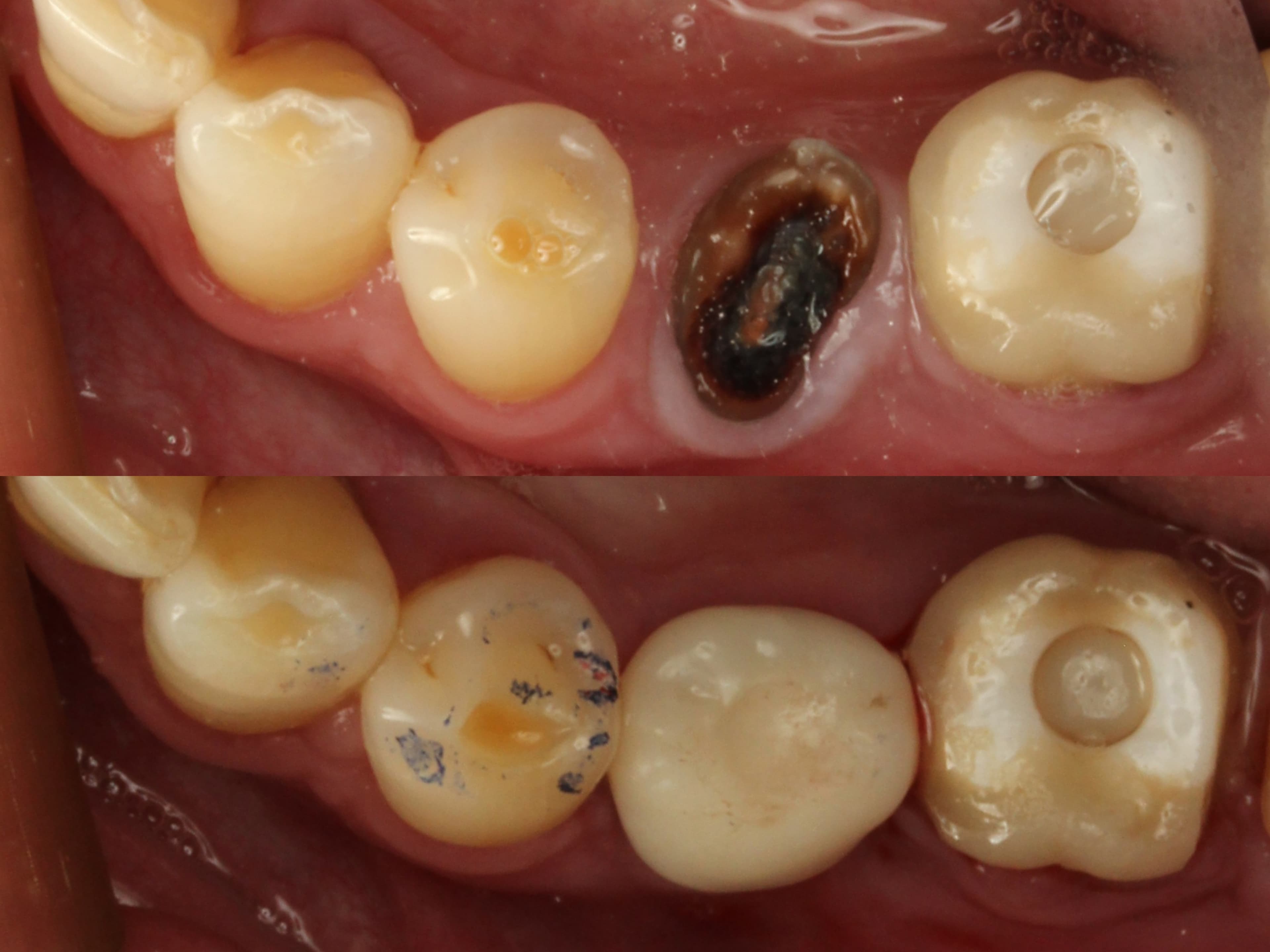 Figure 6: Same-appointment 3D printed implant-borne provisional screw-retained crown using Lumicera A3 (LT)