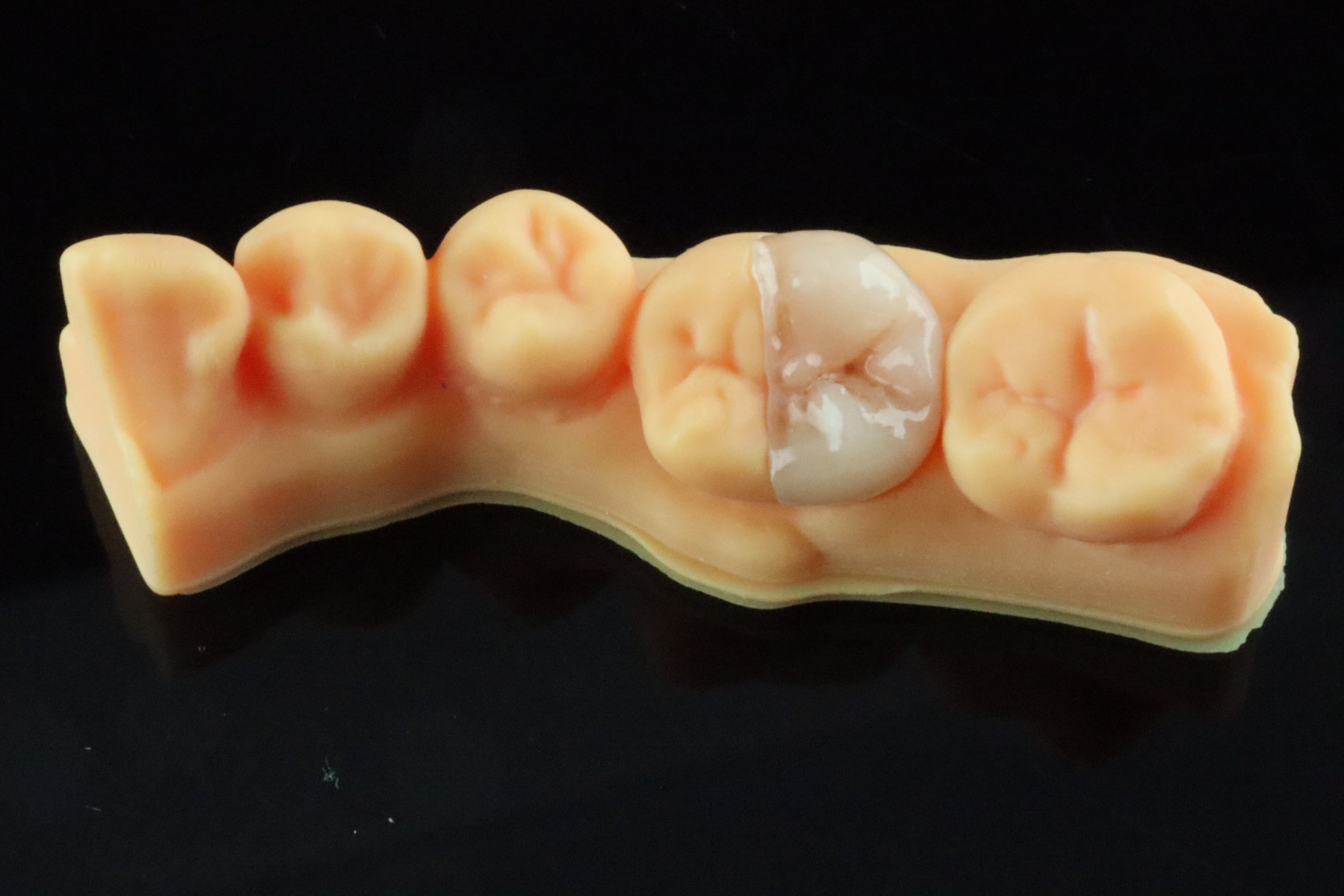 Figure 7: Lumicera MT is definitely the way to go for most anterior and posterior restorations and I’m keen to see what’s around the corner!