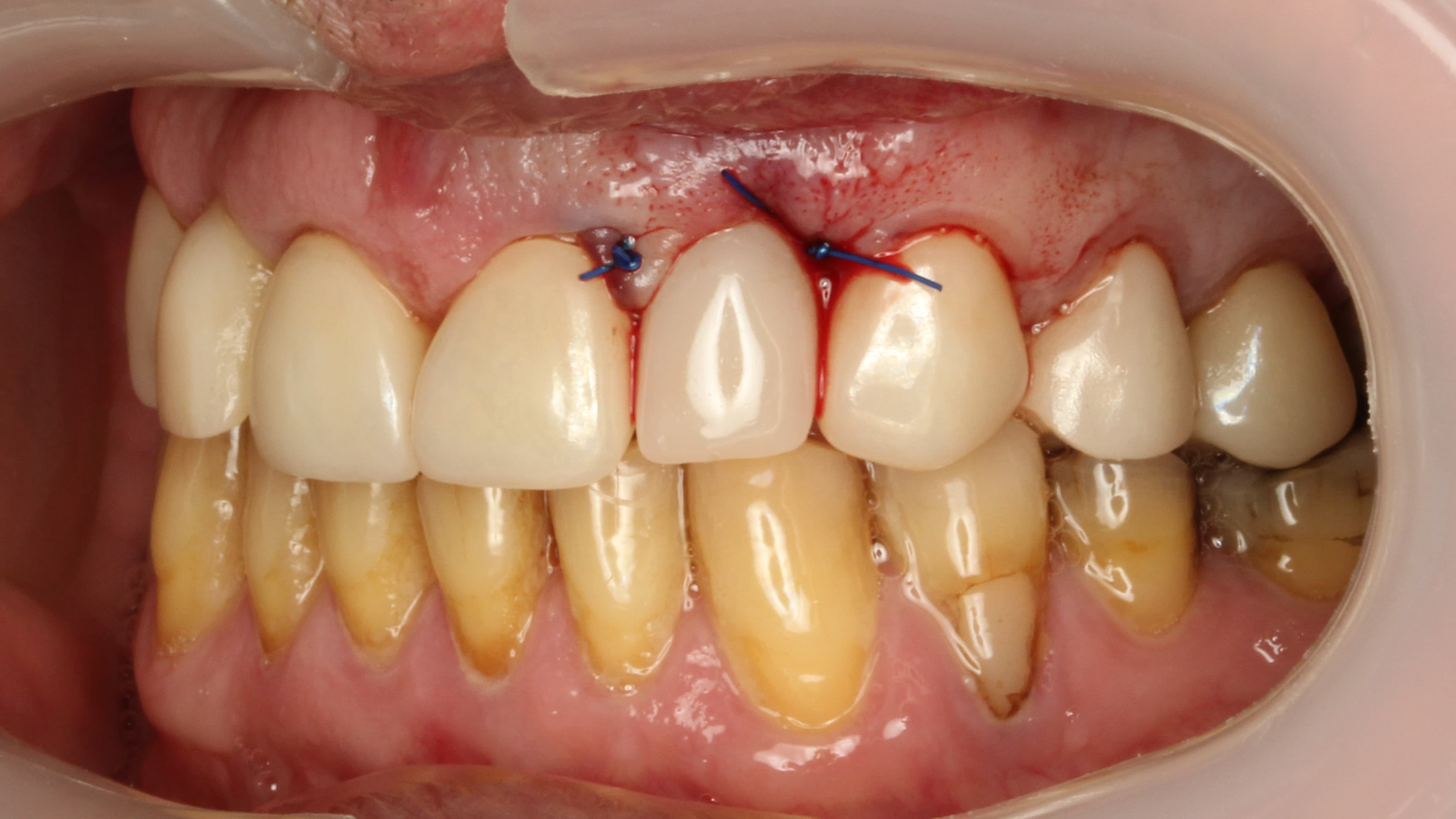Immediate implant-borne provisional crown on the upper left lateral incisor - just polished