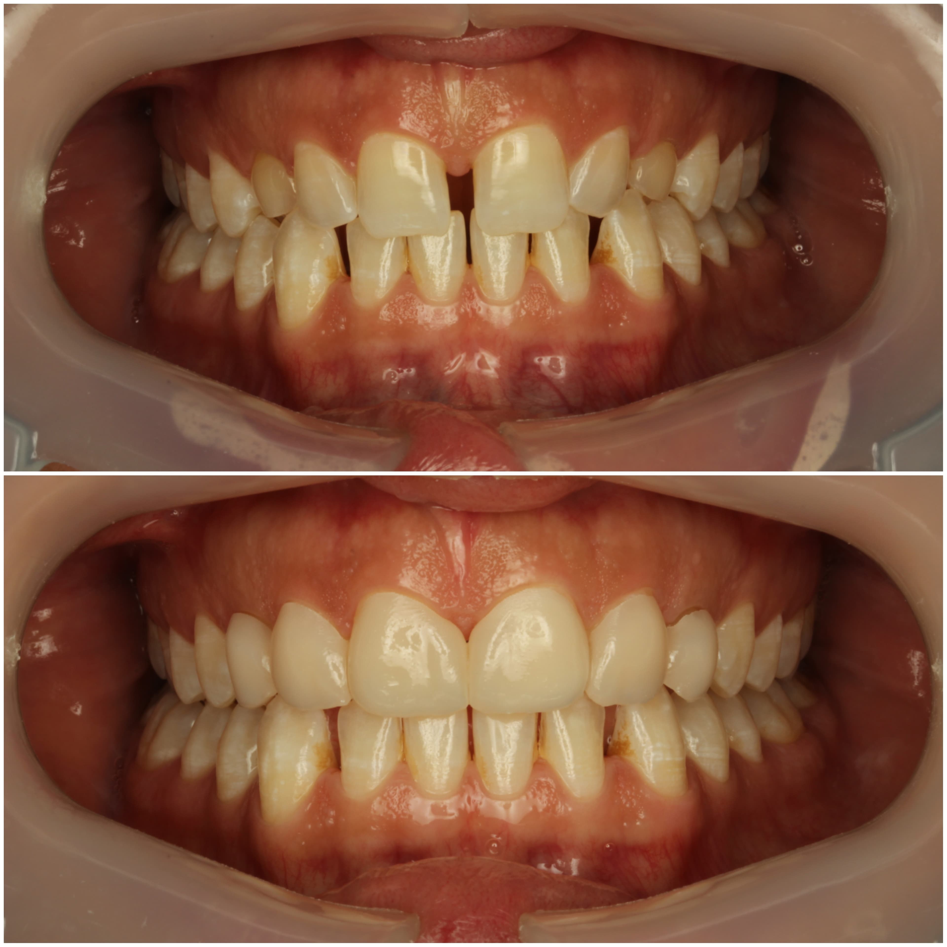 3D printed smile try-in/mock up